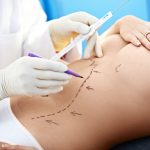 Ako sa zbaviť prebytočného tuku vďaka liposukcii?